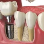 Implantes dental
